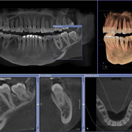 3d-tomografija-zubov_3